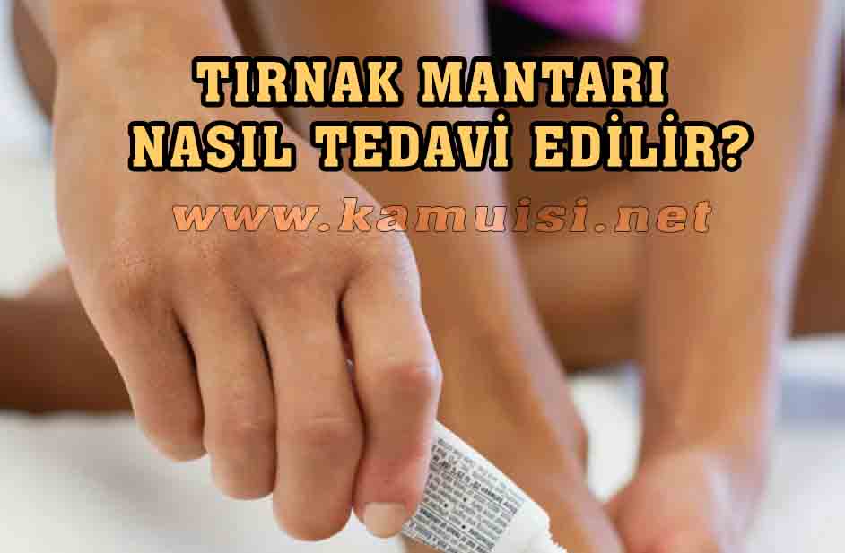 TIRNAK MANTARI NASIL TEDAVİ EDİLİR